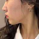 텐써마 300샷 고주파리프팅 통증/ 변화 후기 [청담오라클피부과]