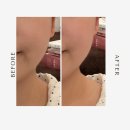 귀건강이혈테라피 | 동탄 귀 이혈테라피 네일팅게일 붓기가 쫙 빠지는 귀 건강 관리 추천