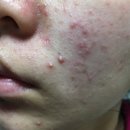 소나무약국 | 세라일론 수딩밤 보습 여드름 트러블 티트리 후기