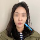 엘리샤 | 압구정피부과 쥬베룩 미라젯 2주차 변화 후기