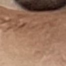 클림의원 | 눈 밑 비립종 제거 후기, 10년 고민 끝에 10분 컷 클림의원 홍대점 솔직후기 &amp; 무통리뷰