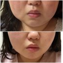 이수역 | 이수역 피부과 온다리프팅 후기 4만줄 리프팅 효과