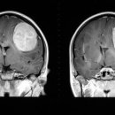 양성 뇌종양[benign encephaloma] 이미지