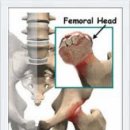 대퇴골두 무혈성 괴사의 stage 등급 이미지