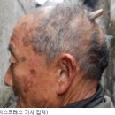 뒤통수에 뿔 난 중국 80대男 출현 '계속 자라' 이미지