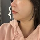 주라울 | [내돈내산] 압구정피부과 울쎄라+빼주라 주사 2개월 차 리얼 후기