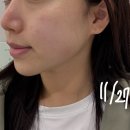 유엔아이 | [미금역] 유엔아이피부과 미금점 첫 리프팅 후기!! 3주차결과 있음!!