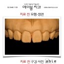 에이블치과기공소 네이버블로그