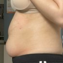 큰복부속구이 | 복부지흡 후기 | 멍,통증, 후관리 1개월차 총정리