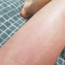 8 | 피부 묘기증 간지러움 홈케어 8주 후기