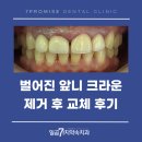 센트로치과기공소 | 벌어진 앞니 크라운 제거 후 교체 후기 현풍치과