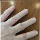 비고르바른건강+고주파 | 비고르바른건강 고주파