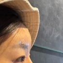 차이 - 파주시 중앙로 247 | 대구이마필러 중구동성로피부과 시술전후차이 효과 추천 후기