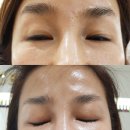 인셀덤US | [역곡피부관리] 인셀덤 사용후기 . 효과보는사용방법★★