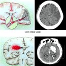 사망률 1위 뇌혈관 질환24 /중풍,뇌졸중,뇌경색,뇌출혈~! 이미지