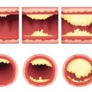 동맥경화 증상과 원인, 예방법은? 이미지