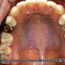 신경 치료 후 부러진 치아의 회복 ▶ 임플란트시술 이미지