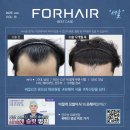 포헤어의원 | 압구정모발이식 포헤어의원 남자M자탈모 1년 후기