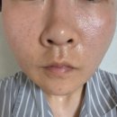 스킨25 - 영주시 | 울산 남구 피부과 콜라겐 스킨부스터 셀르디엠 변화후기
