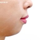 태기출치과의원 | 돌출입교정 발치를 꼭 해야 하나요? (여자분 비발치 치아교정 후기)