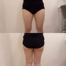 3층바른약국 | [팔/허벅지안쪽 람스 후기]상담, 시술 당일, 2일차(통증, 멍, 소소한 팁 등 자세한 후기)