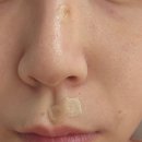 오늘약국 | 신촌 노벨의원 점제거 점빼기 관리 4주 경과 후기(feat. 마데카솔 vs 재생크림)