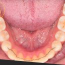 와동킴스치과의원 | [성남 치과] 맨 끝 어금니 충치, 인레이 대신 '레진 빌드업'으로 감쪽같이 치료한 후기