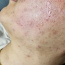 호연피부관리실 | 순천피부관리 ) 너만 모르는 턱피지 없애는 방법