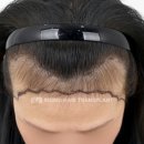 정암의원 | [모모의원 대구점] 여성 헤어라인 교정 모발이식 리얼후기 | 모제림출신 강동우 대표원장