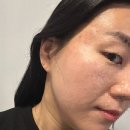 몽프로디 | 신림여드름관리 몽프로디 첫방문 솔직후기