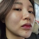파티마미소약국 | 극복기 현재진행형 | 애플 토닝 관리와 독시크정, 신풍 겐타마이신 황산염크림 내 돈 내산 솔직한 후기