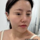 송파 가락동 : 얼굴윤곽 레아쥬 관리 솔직 후기 [ 드로아뷰티 엑스날 헬리오시티점 ]
