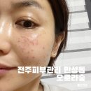 전주피부관리 만성동 오로라숲 플라즈마 후기 관리방법