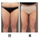 신사-102 | 신사 허벅지지방추출주사 가격 붓기까지 8주차 찐 후기