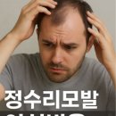 (주)한국메디칼 | 정수리모발 이식비용 총정리 (장단점 및 후기)