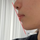 비발치 교정일기(11) 9~10번째 월치료 - 미니 스크류 식립, 교정 스크류 통증 후기, 당기기 시작, 블트