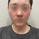 지음프라자 | 충주 더고운의원 통증없는 쿨페이즈리프팅 후기