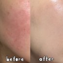 신생사 | 피부유산균 가려움 원인 알고 구매한 내돈내산템 솔직 후기