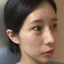 뉴센스의원 | 역피부과] 리제반 PN, 프리미엄물광주사 하이쿡스 일주차 솔직후기 💗: 리쥬란보다 안아픈 가성비 시술 추천