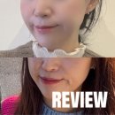 보이다 안경 | 리쥬란 주사로 부작용 없이 피부결 시술 받은 후기