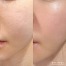 신세계의료기 | 아픈 스킨부스터가 싫다면? 큐어젯 + 쥬베룩 통증, 다운타임 걱정없이 모공관리 받은 후기