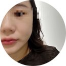 대구의원 | 대구유니티의원 내성없는 코어톡스 턱 보톡스 내돈내산 후기