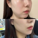 마이디데이 브로멜라인 내돈내산 한달 솔직 후기 먹는법 붓기 관리 효과 부작용
