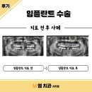 엠치과의원(시지점) | 엠치과시지점) 임플란트 사례 같이 알아볼까요?