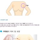 수원강남여성병원에서 알려드리는 &#39;부유방&#39;이란? 이미지