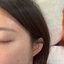 서울한의원 | 서울편평사마귀 무제한성지 한의원 다녀온 속시원한 후기