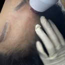 빌리브메디칼 | 뷰티메이커👩🏻ㅣ대구 두류동 플라즈마 레이저로 잔주름 관리 받은 후기
