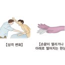 간성 뇌병증 이미지