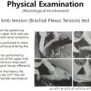 상완신경총 긴장 검사 (사각근 증후군과 목디스크 검사) 이미지