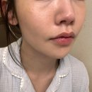 내돈내산/대구 스킨바이브, 팔자주름필러 맞고온 후기(전후비교)